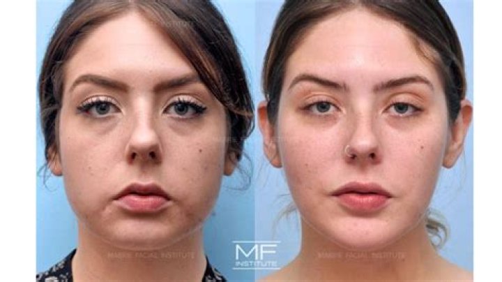 Can Radiesse help jowls?