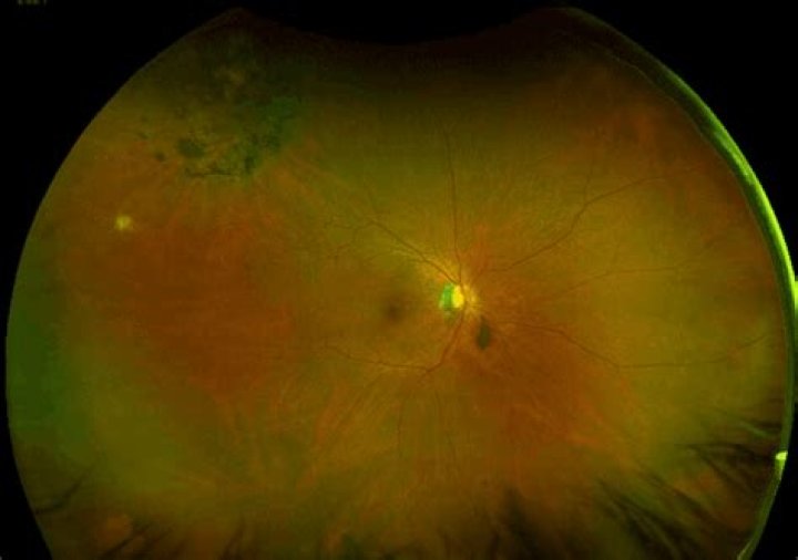 Can retinal scarring be fixed?