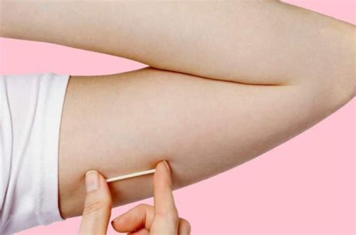 Does Implanon cause weight gain Australia?