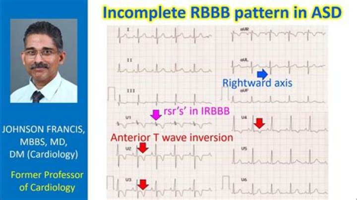 How do you diagnose incomplete RBBB?