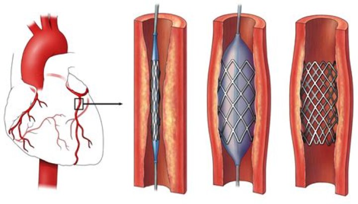 How is stent thrombosis treated?