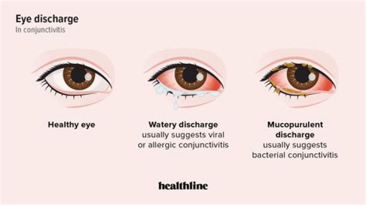 How long does it take for bacterial conjunctivitis to clear up?