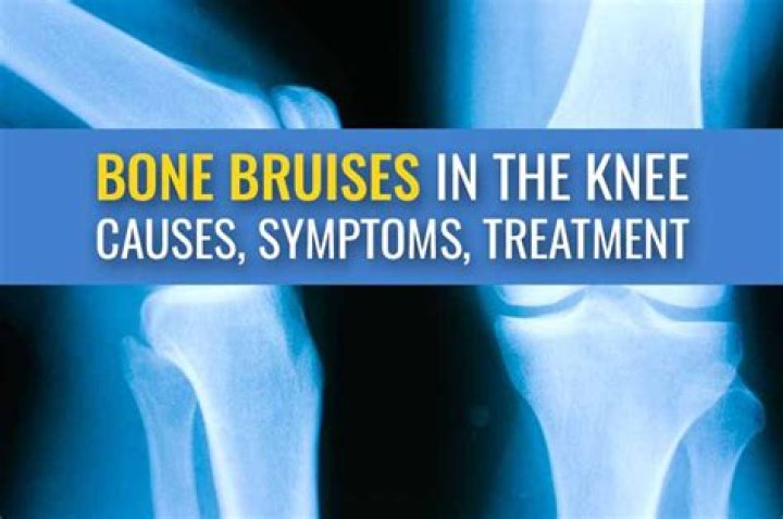 How painful is a bone bruise in the knee?