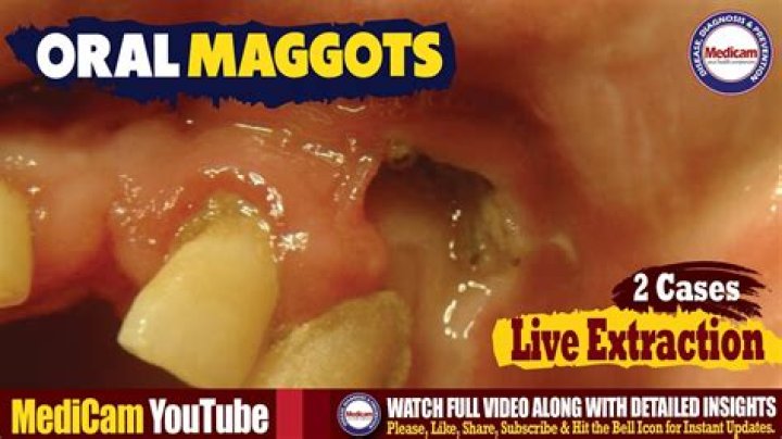Is it possible to have maggots in your gums?