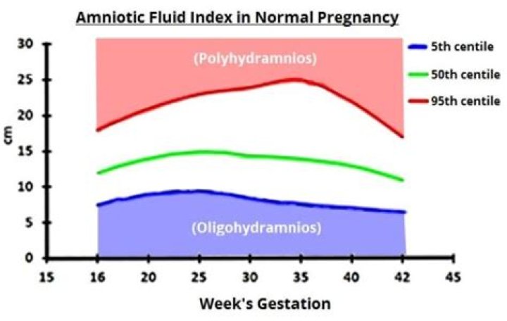 What causes high amniotic fluid in third trimester?