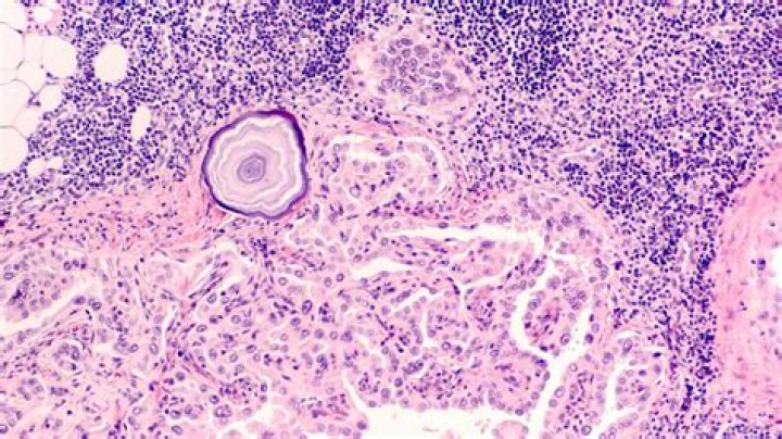 What do oncologists do when they get cancer?