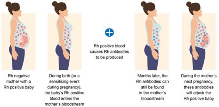What happens if Im rhesus negative and pregnant?