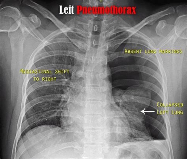 What is a pneumothorax Radiopaedia?