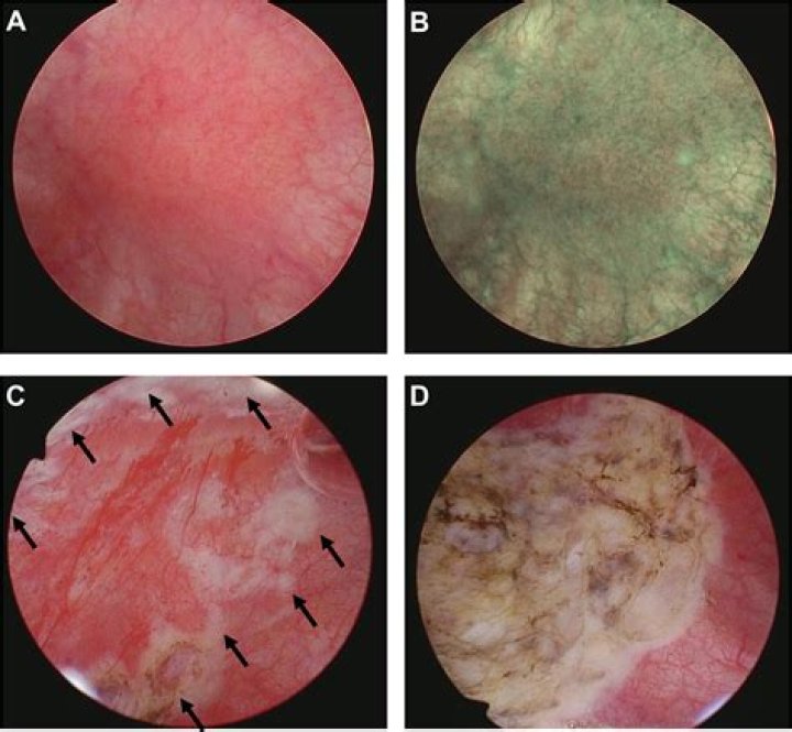 What is Hunner lesion?
