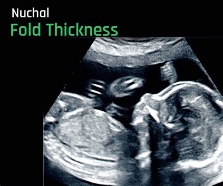 What is normal thickness of nuchal fold?