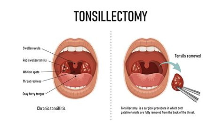 What structures are removed during tonsillectomy?