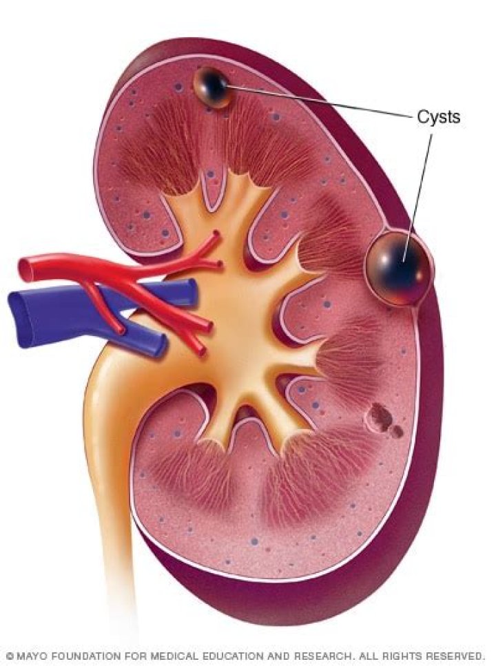When should I worry about a kidney cyst?