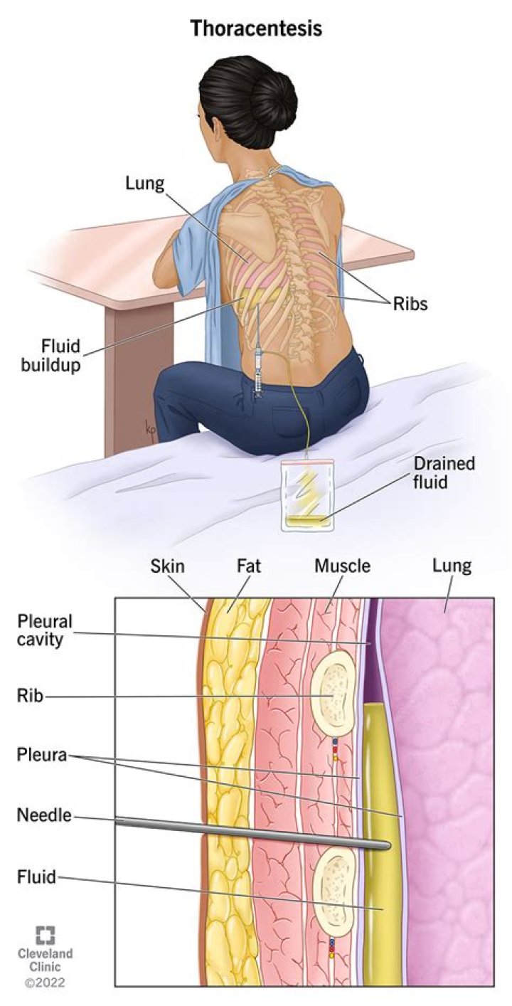 Where is Usmle thoracentesis performed?